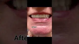 Be nice to your dentist ☺️ #dentist #dentalmakeover #beforeandafter #viralshort #smile #dentalcare