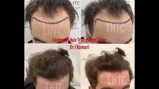 Hair Transplant UK - 12 Months Results Hairline Surgery - Dr Jyostna Kumari