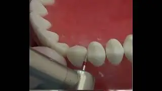 Ortho IPR Bur Interproximal Enamel Reduction FG Dental Diamond ,Reco-Dent Made in Taiwan
