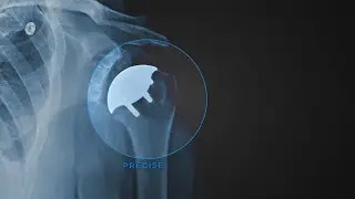Catalyst&rsquo;s Archer&trade; CSR Total Shoulder System Animation