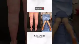 Lipedema Before and After Transformation | LippyLipo #lipedemaawareness #beforeandafter #lipedema