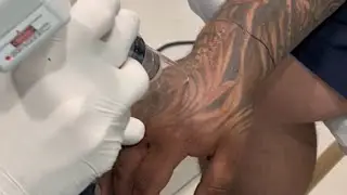 Laser Tattoo Removal Procedure | 1 Aesthetic Plastic Surgery