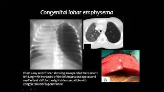 Pediatric chest imaging IV DRE Prof  Mamdouh Mahfouz HD