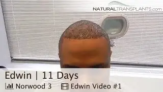 Hair Transplant Scar and Suture Removal with Dr Kevin Blumenthal  | Hair Transplant Scars (Edwin)