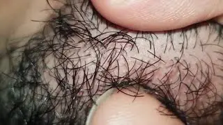 Relaxing ASMR Ingrown hair | Massage therapy Satisfying | shorts video #asmr #video