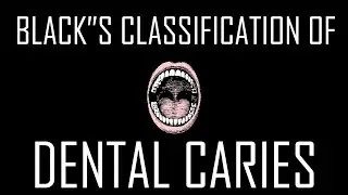 4- Black's Classification of Dental Caries