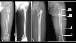 Pediatric Femoral Shaft Fractures