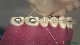 ORTOCERVERA / Ortodoncia: Ligadura Contínua - Brackets Autoligado Camaleón
