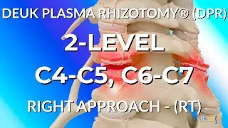 FACET JOINT RHIZOTOMY - C4-C5, C6-C7 - LIVE - Laser Spine Surgery