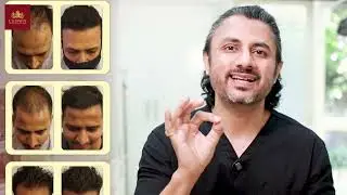 Are You the Right Candidate for a Hair Transplant? | Crown Hair Transplant | Dr. Mayank |