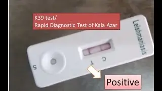 K39 test poaitive | Kala Azar| Leishmaniasis | Visceral Leishmaniasis |RDT| k39 test| Rapid test