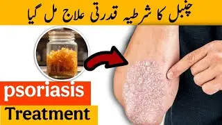 Psoriasis Ka Asli Ilaj mil gya | 100% Natural Remedy | Psoriasis Treatment at Home in Urdu / Hindi