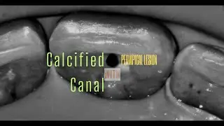 Calcified Maxillary Central Incisor with Periapical lesion