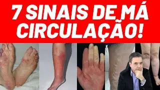 7 sinais de MÁ CIRCULAÇÃO - Fique alerta aos sinais! - Dr. Alex Vascular