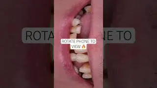 Life changing full mouth implant rehabilitation by Dr. Billal. 😍🔥