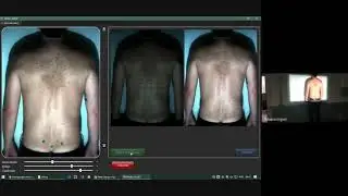 Miotec - Demonstra&ccedil;&atilde;o Cl&iacute;nica do Scanner Postural Vert 3D