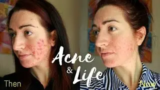 MY ACNE UPDATE 2017 // LIFE UPDATE // Jess Bunty