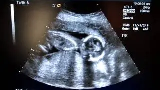 Twin ultrasound 18 weeks