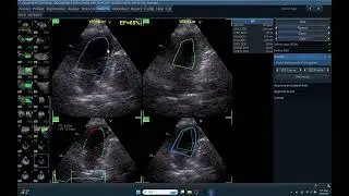 IQ 386 AUTOEF  ECHOPAC ANALYSIS ECHOCARDIOGRAPHY LA:LA:RV AFI AUTOEF SMALL ANIMAL