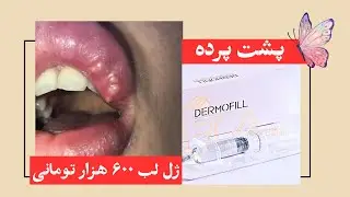 fake filler-درموفیل