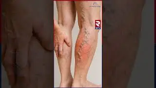 Avis Vascular Centre | Non Surgical Treatment | Best Varicose Veins Treatmen𝐭 | Avis Hospitals | RTV
