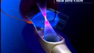 Sonablate&reg; HIFU Animation