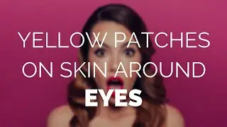 Yellow patches on skin around eyes, what is it?