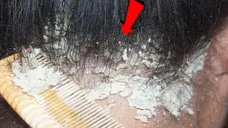 Dandruff Removal Long Hair Guys#558