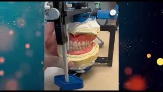 Class 3 Underbite Dentures Update