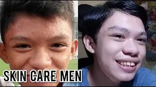 PAANO NAWALA PIMPLES KO (TIPID!) | Paano Mawala Ang Pimples in 1 Day | Skin Care Routine Men Ph
