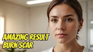 Burn Scar Treatment Result 🔥 1 Session Laser Combo | Kayakalp Clinic