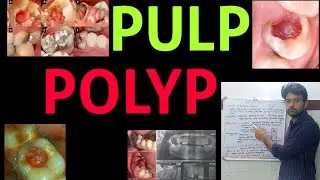 Pulp polyp
