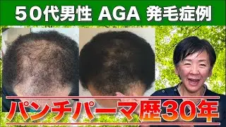 【 50代男性AGA 発毛症例 vol7 】パンチパーマ歴30年 月2回のパーマと毛染め！頭皮がだんだん透けていく！なんとかしたい！でもパンチパーマはやめれない！