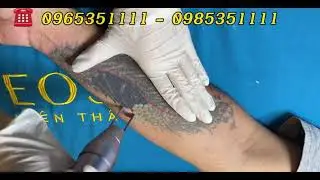 🔔XO&Aacute; SẠCH H&Igrave;NH XĂM BẰNG LASERPICO SURE #shorts #lamdep #xoaxam #xuhuong
