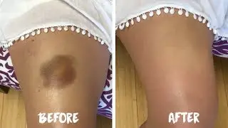 How to Cover a Bruise with Waterproof Makeup