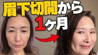おかげ様で眉下切開手術から1ヶ月経ちました！