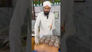 Fire Cupping Therapy For Back Pain | Dry Cupping Therapy For Lower Back Pain Doctor Usman Faiz 2026