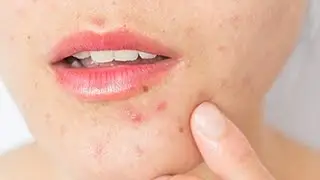 Clear Acne Scar face mask, Treatment Acne skin care. Salona Tips