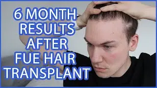 FUE Hair Transplant | Month 6 | FULL RECAP Surgery, Growth, Before & After, Advice | Progress Update