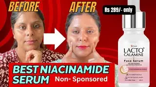 Lacto Calamine 10% Niacinamide Serum Review | Is this for oily skin?