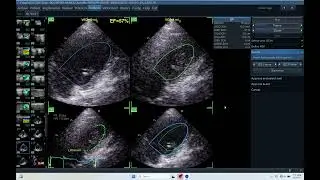 IQ 464 AUTOEF ECHO PAC ANALYSIS ECHOCARDIOGRAPHY