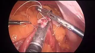 Ethicon 4000 Endomechanical Stapler - Laparoscopic Roux-En-Y Gastric Bypass by Dr. Elizabeth Dovec
