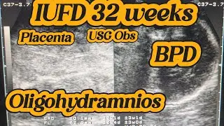 IUFD 32 Weeks | 8th Month Fetal Death | Oligohydramnios | Fetal Death 3rd Trimester