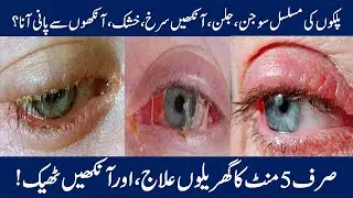 Blepharitis,Causes,Signs & Symptoms|Treatment|Eye infections Home remedies|In Urdu\Hindi#blepharitis