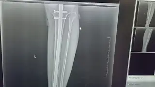 Tibia Fracture Recovery || Darshan Burnule || Maharashtra #fracture #therapy #doctor 