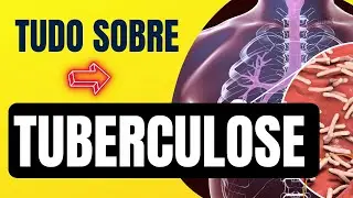 TUBERCULOSE RESOLUÇÃO DE QUESTÕES
