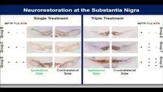 Karakatsani - Neurorestoration of nigrostriatal pathway with FUS brain drug delivery (2016)