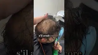 Hair transplant or hairpiece? A clear explanation