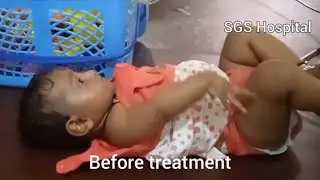 Erb&rsquo;s Palsy or Brachial Plexus Injury optimally recovered : SGS Hospital, Mysore - 31