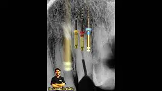 Routine ENDO with Motion Graphics| Live RCT procedure| Dr khubaib Hafiz